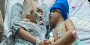 Récord: Separan con éxito a siameses de 3 años unidos por la cabeza